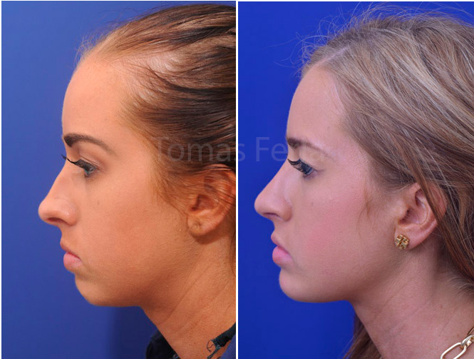 Chin implant Colombia