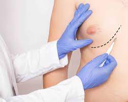 Gynecomastia Surgery Medellin