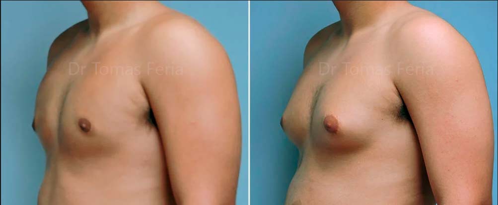 Gynecomastia Surgery Medellin