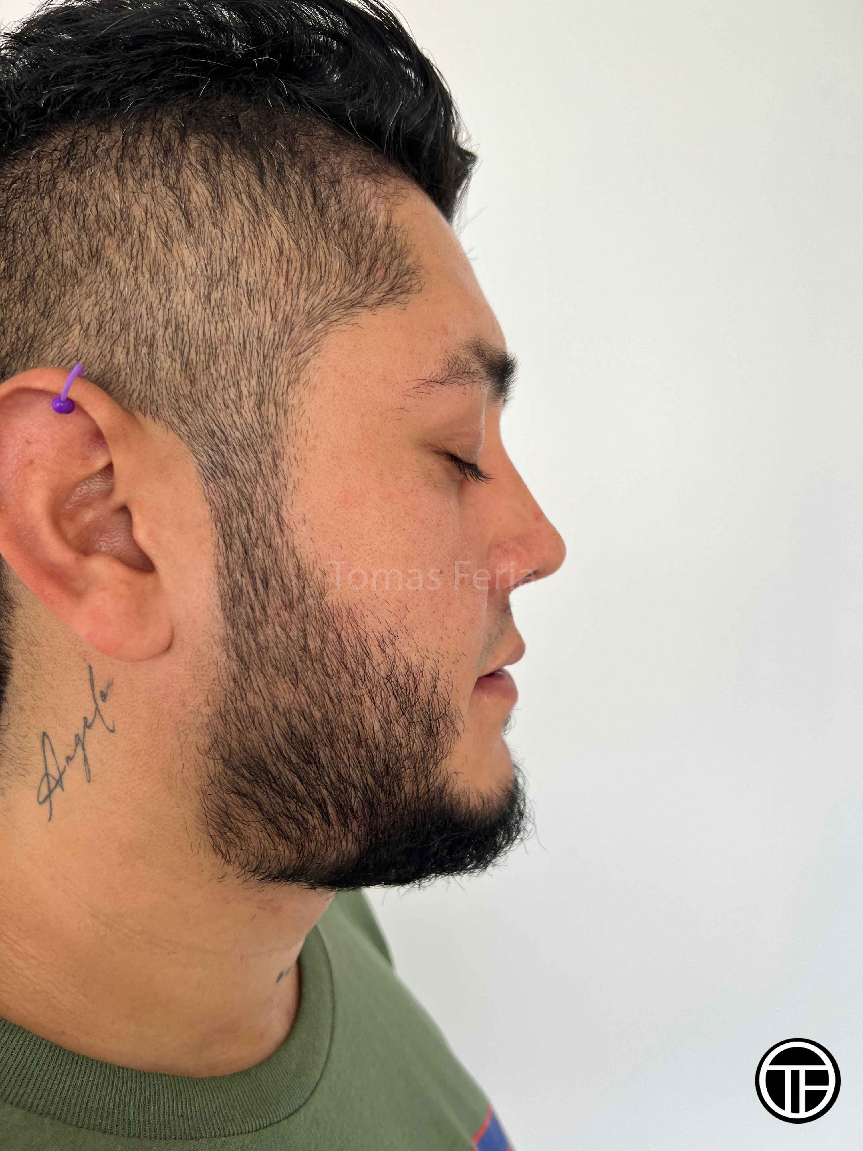 Revision Rhinoplasty Medellin