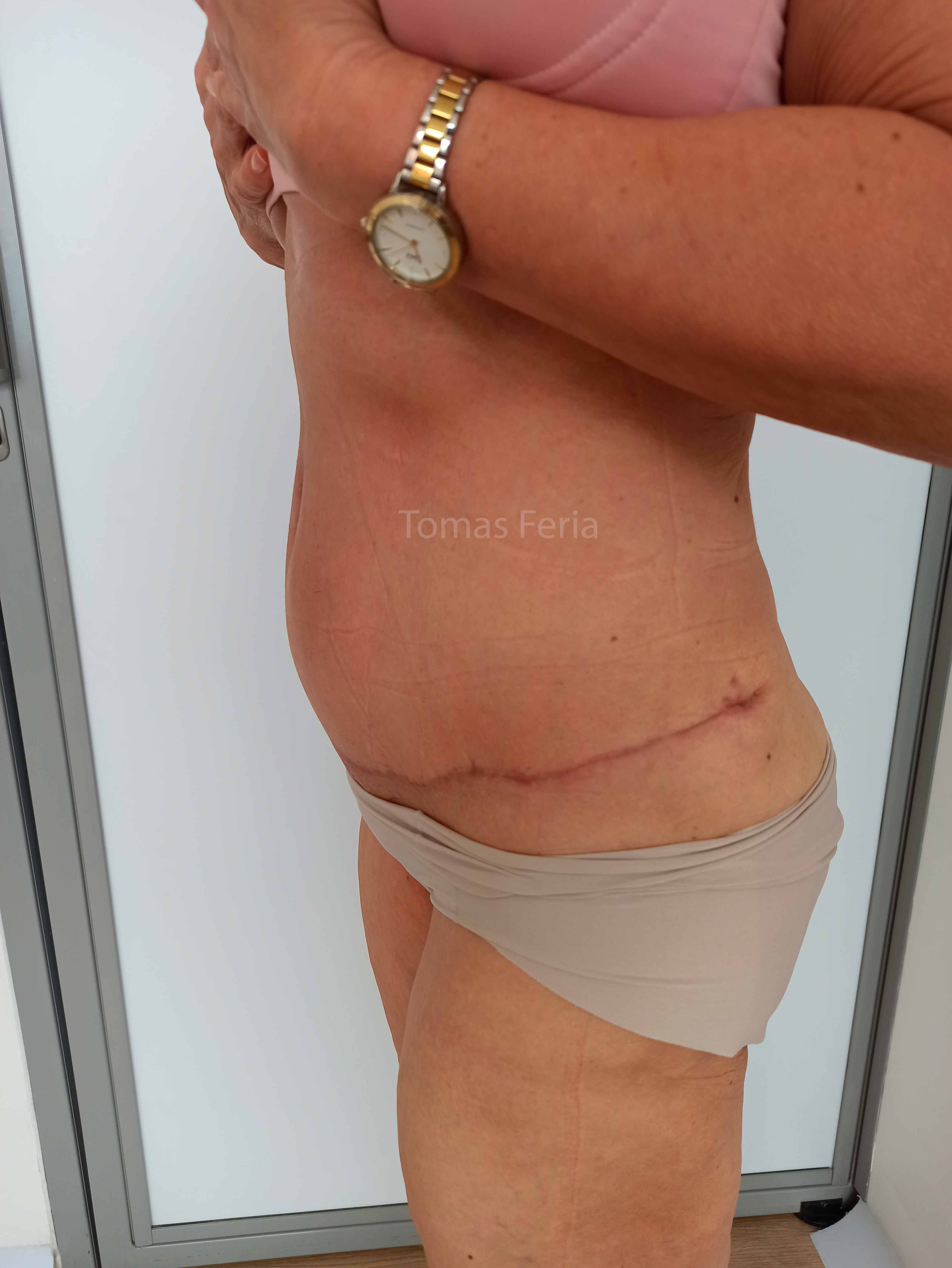 tummy tuck Medellin