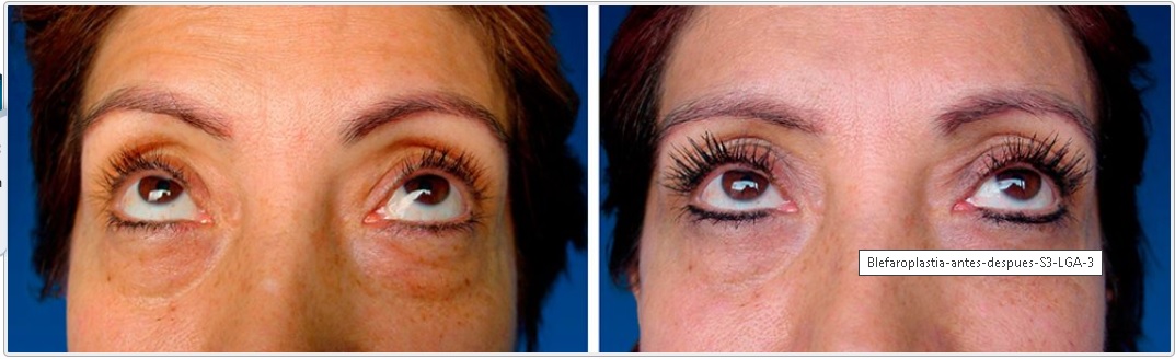 eyelid surgery colombia