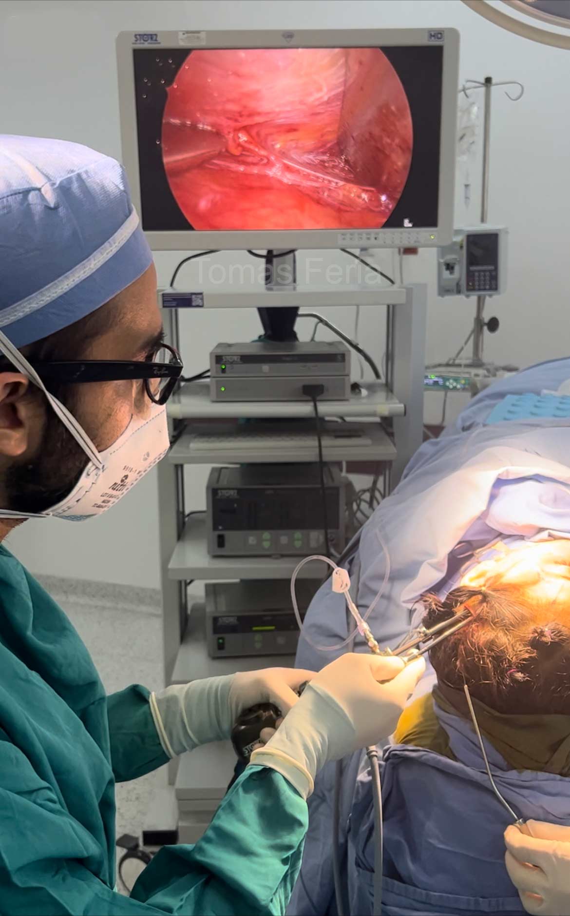 midface lift colombia