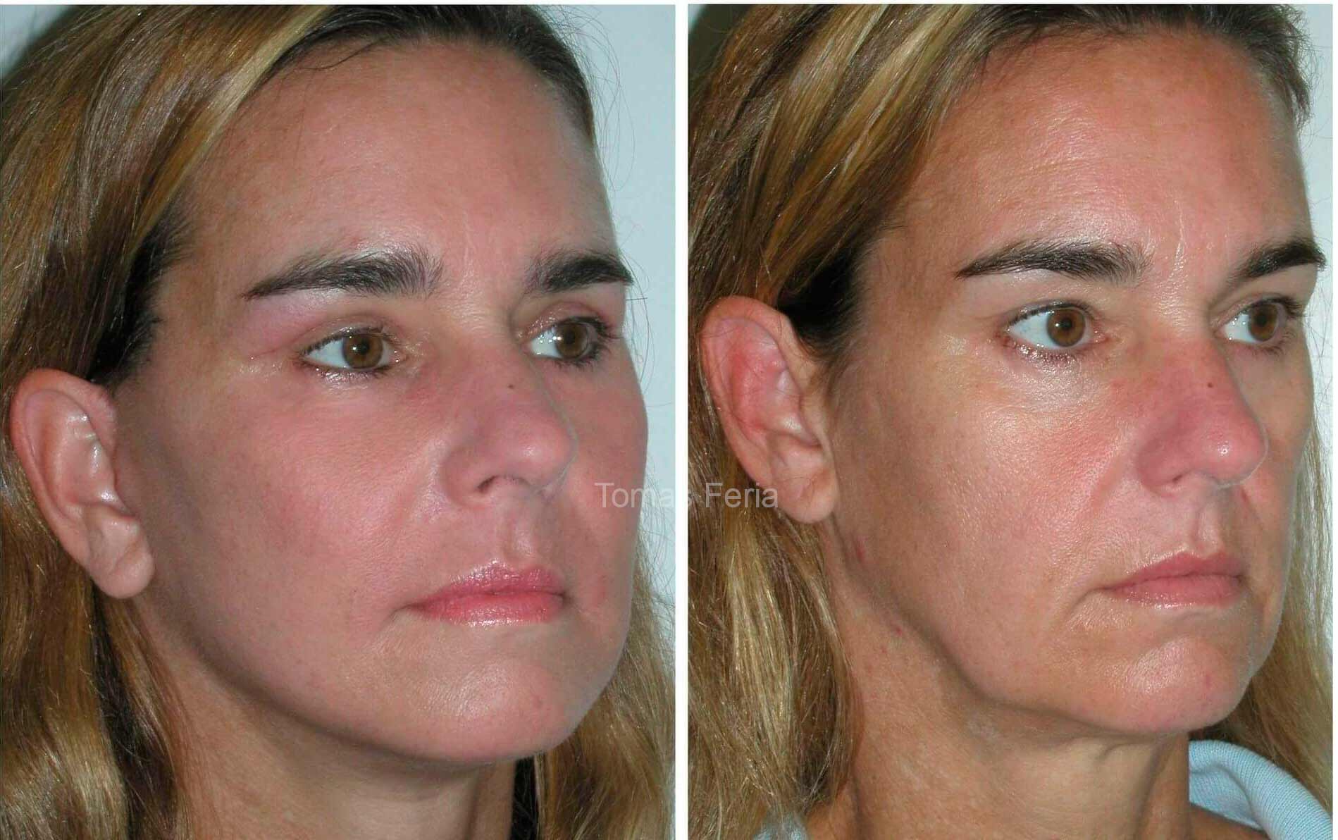 midface lift colombia