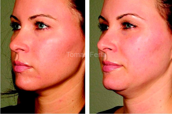 midface lift colombia