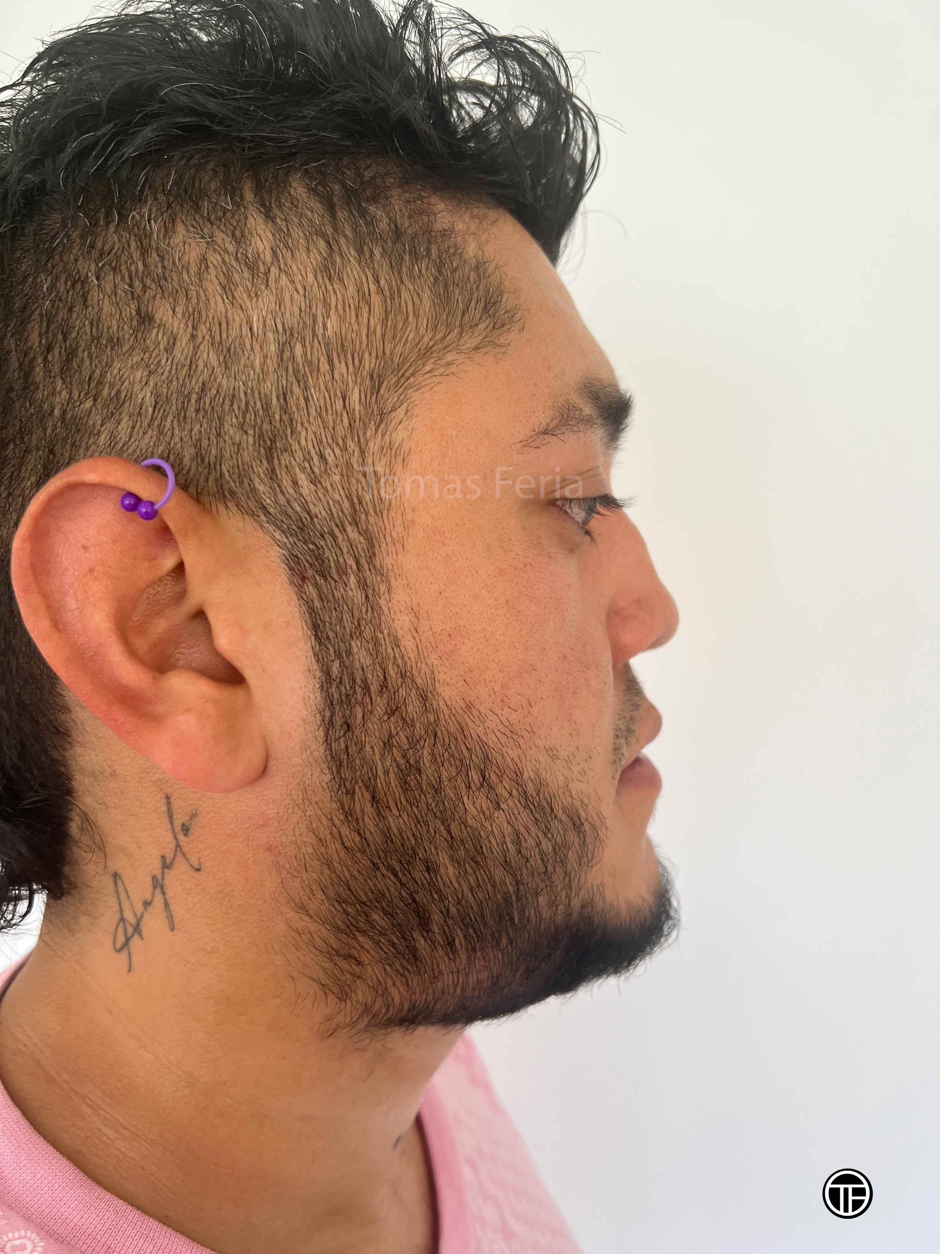 rinoplastia secundaria Medellin